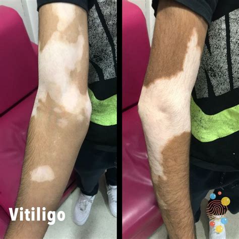 Vitiligo Skin Deep