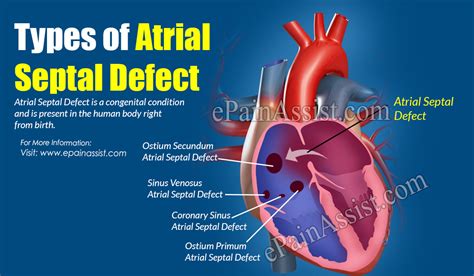 Types Of Atrial Septal Defect Its Causes Symptoms And Treatment