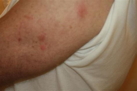 Itchy Red Welts On Right Arm Picture Of Days Inn Chester Chester