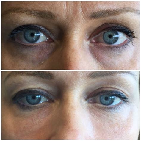 Restylane For Tear Troughs In Austin Filler Under The Eye Diminishes