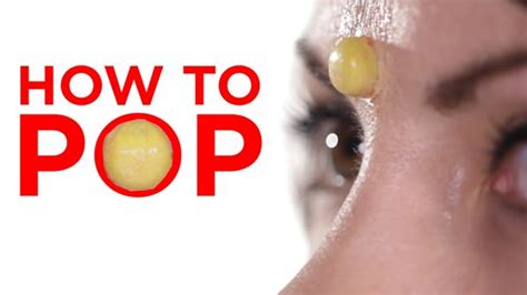 How To Pop A Pimple The Right And Best Way