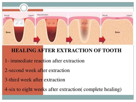 The Basics Of Tooth Extraction Dr Nechupadam Dental Clinic