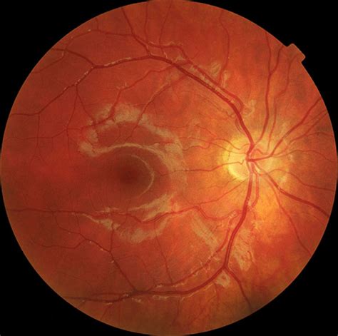 Major T Focuses Efforts On A Rare But Devastating Genetic Eye Disease