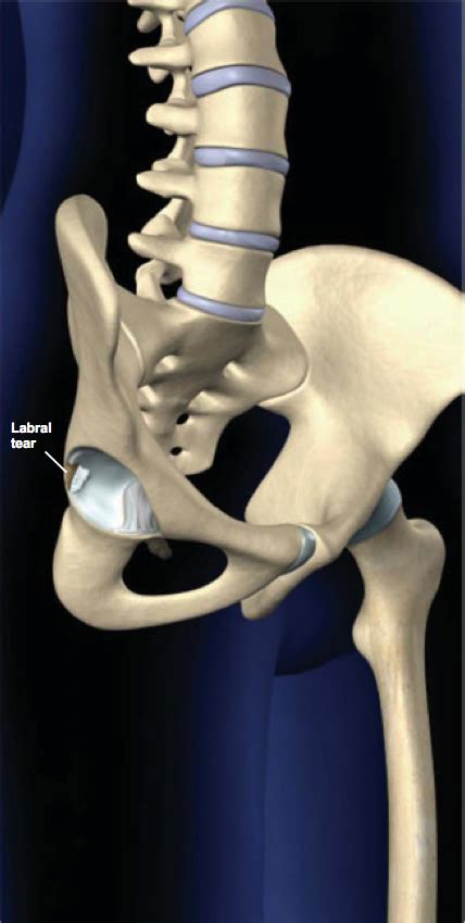 Torn Hip Ligament Repair