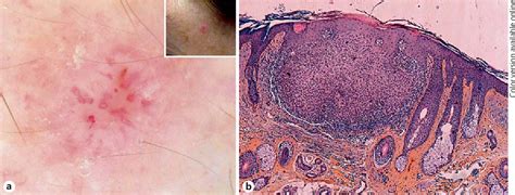 Figure 1 From Inverted Follicular Keratosis Dermoscopic And
