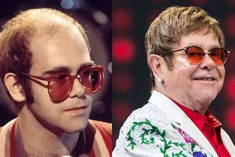 Unbelievable 10 Celebrities Who Have Had Hair Transplants