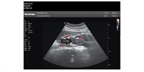 Abdominal Ultrasonography Images In The Epigastric Sagittal View A