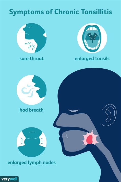 Chronic Tonsillitis Causes And Symptoms