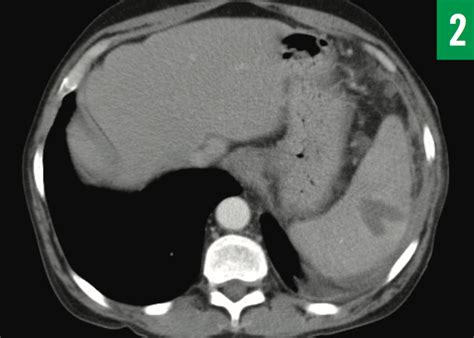 Splenic Abscess Due To Salmonellosis Consultant360