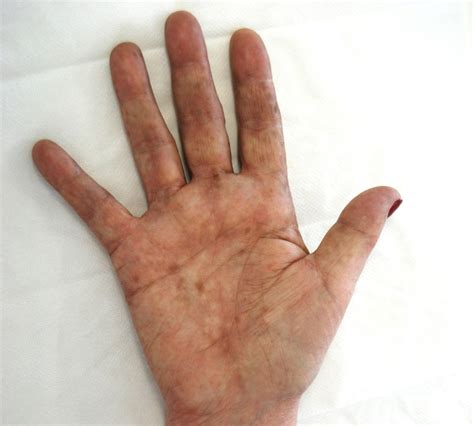 Yellow Spots On Palms Of Hands
