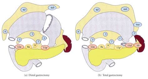 Lymph Node Dissection According To The Japanese Gastric Cancer