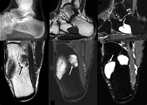 Intraosseous Lipoma Of The Calcaneus Developing In An Intraosseous
