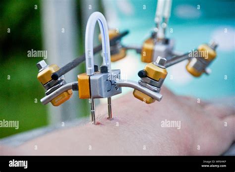 External Fixation Hi Res Stock Photography And Images Alamy