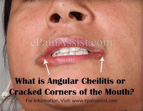 Skin Care Tips That Work For Busy People Cracked Corners Of Mouth