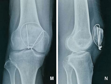 Pathologic Fracture Of The Patella Secondary To A Gouty Tophus