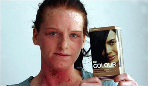 Hair Dye That Caused An Allergic Reaction 6 Pics