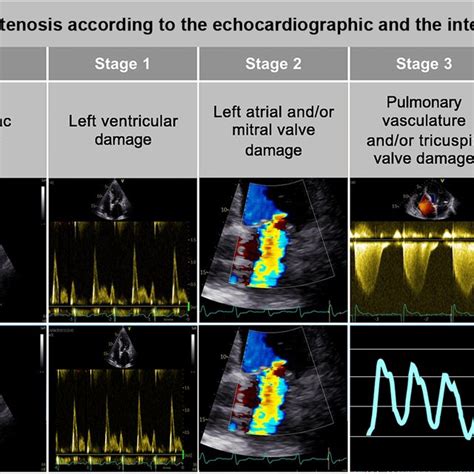 Classification According To The Two Analyzed Aortic Stenosis Staging Download Scientific