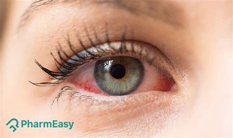 Effective Home Remedies For Red Eyes Pharmeasy Blog