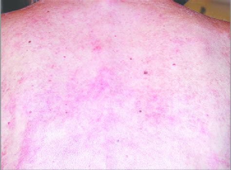 Skin On The Patients Back The Diffuse Faintly Erythematous Rash On