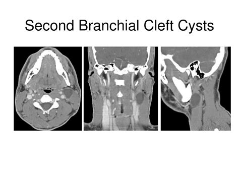 Ppt Branchial Cleft Cysts Powerpoint Presentation Free Download Id