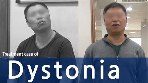 Dystoniacervical Dystoniaspasmodic Torticollis 사경증 치료사례 근긴장이상증
