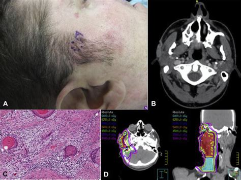 Adjuvant Radiotherapy In High Risk Cutaneous Squamous Cell Cancer Of