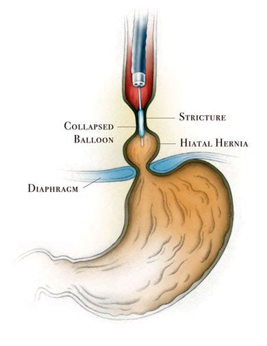 Peptic Esophageal Stricture Memorial Hermann