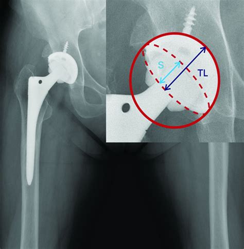 The Reliability And Accuracy Of Measuring Anteversion Of The Acetabular