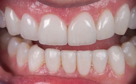 Case 16 Anterior Esthetic Makeover With Crowns Veneers And Invisalign