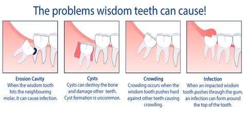 How Wisdom Teeth Are Removed Wisdom Teeth Removal