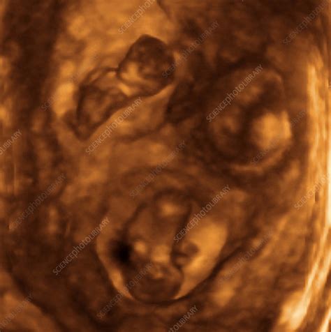 Triplets 3 D Ultrasound Scan Stock Image P6800636 Science Photo