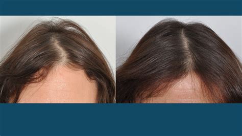 Hair Loss Treatments Non Surgical For Women Dr David Rosenberg