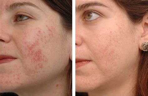 Ipl Photofacial For Acne Scarring Before And After Yelp