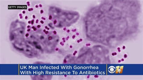 First Case Of Super Resistant Gonorrhea Reported In UK YouTube