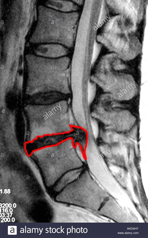 Mri Scan Clearly Showing A Slipped Disc Pressing On The