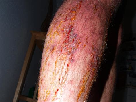 Infected Poison Ivy Rash Pictures