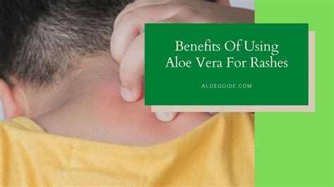 Aloe Vera For Rashes Research Efficacy And More Aloe Guide