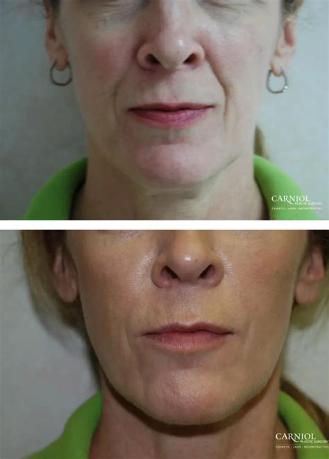 Facial Fillers Summit Nj Carniol Plastic Surgery