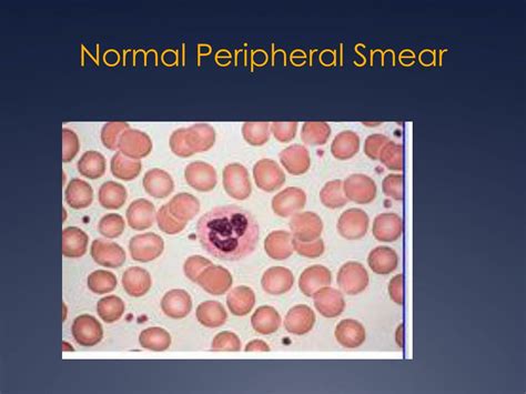 Ppt Anemia Powerpoint Presentation Free Download Id4386093