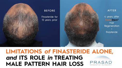 Why Is Finasteride Not Working Dr Prasad Blog