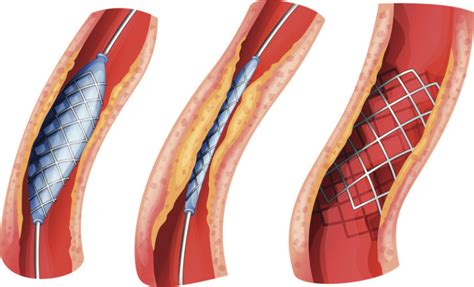 questions heart patients should know to ask about stents blackdoctor