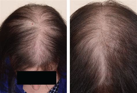 Medication For Hair Loss Female Shop Prices Save 45 Jlcatjgobmx