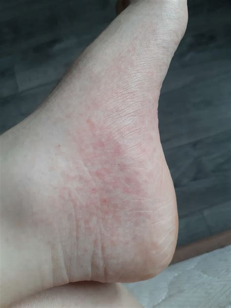 Появилась сыпь на ногах и на руках Вопрос дерматологу 03 Онлайн