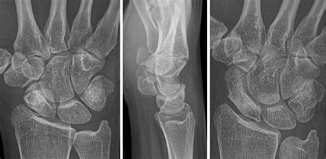 Scaphoid Fracture Avascular Necrosis