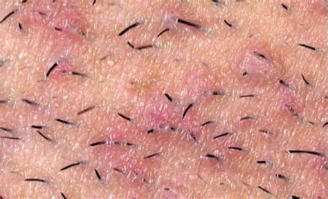 How To Deal With And Prevent Ingrown Hairs Musely
