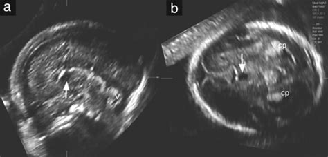 Agenesis Of The Fetal Corpus Callosum Sonographic Signs Change With