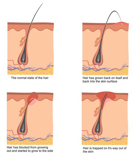 It can cause inflammation, pain and tiny bumps in the area where the hair was removed. How to Prevent Ingrown Hairs on Face From Shaving...