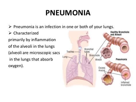 Pneumonia is a bacterial, viral, or fungal infection of the lungs that causes the air sacs, or alveoli, of the lungs to fill up with fluid or pus. Pneumonia Signs, Symptoms & Treatment - My Health Maven
