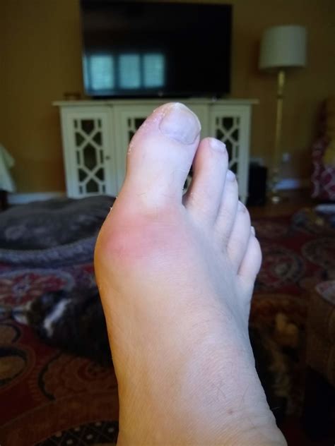Intermittent Painswelling In Big Toe Joint