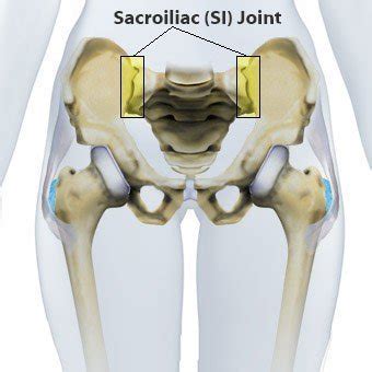 Si Joint Sprain Pain Dysfunction Perth Sports Chiropractor